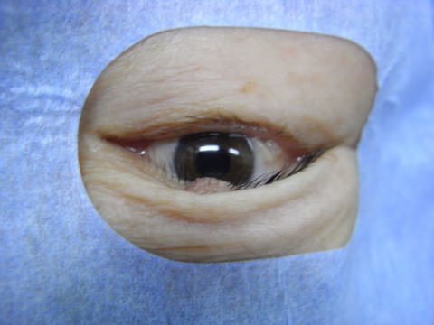 横浜相鉄ビル眼科医院 眼瞼結膜腫瘍（がんけんけつまくしゅよう 